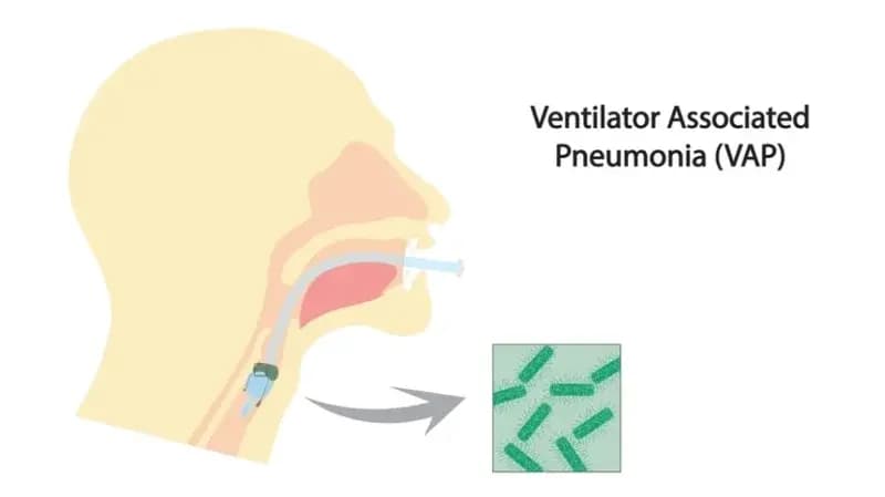Ventilator-associated pneumonia (VAP) - Causes, Symptoms and Treatment Options Ventilator-associated pneumonia (VAP) - Causes, Symptoms and Treatment Options