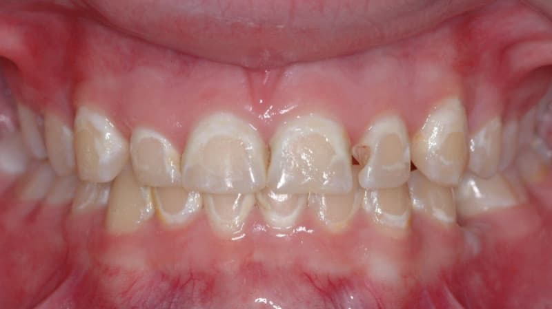 Metallic Taste in Mouth - Causes, Symptoms and Treatment Options Metallic Taste in Mouth - Causes, Symptoms and Treatment Options