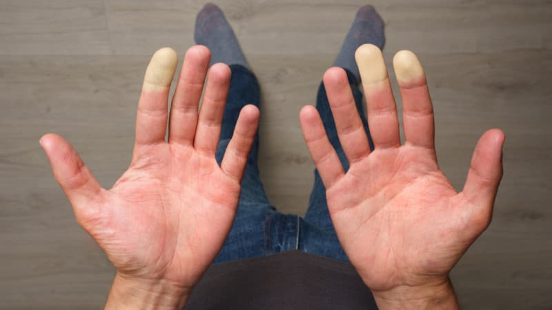 Raynaud's Disease - Symptoms, Causes, Risk Factors and Treatment options | Narayana Health Raynaud's Disease - Symptoms, Causes, Risk Factors and Treatment options | Narayana Health
